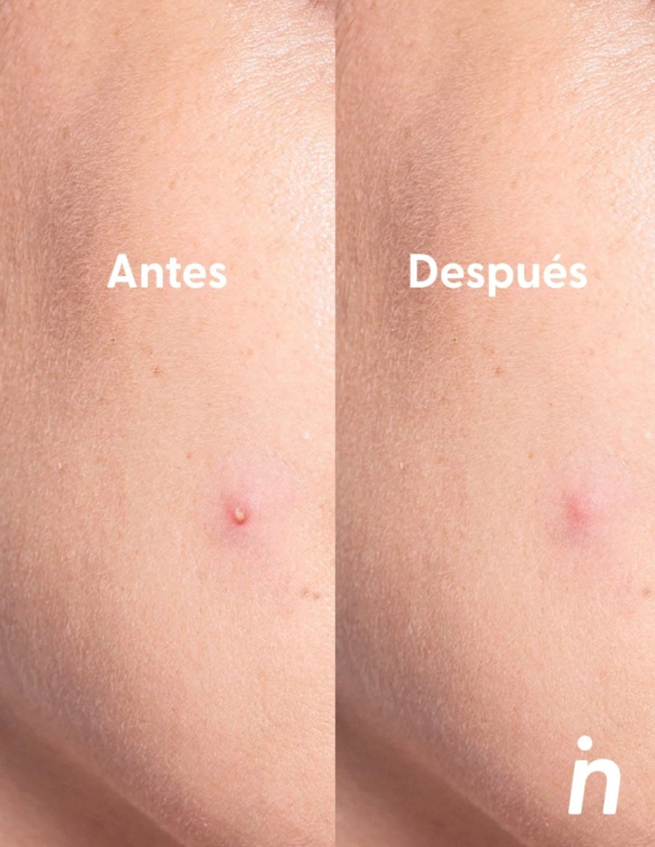 Parches para acné Invisibles Nipskin